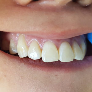 Aesthetic Fillings