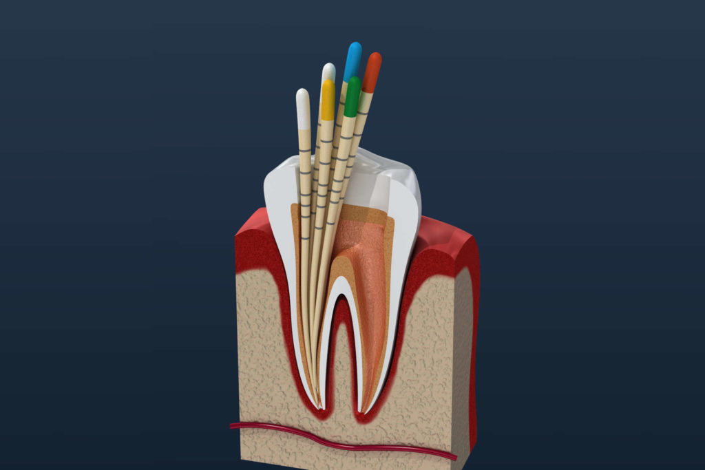 Dental Gigi Root Canal