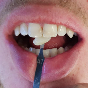 In Chair Teeth Whitening