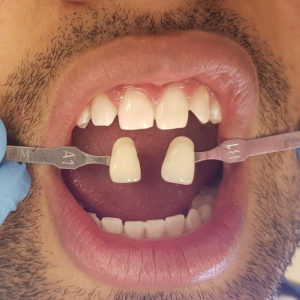 In Chair Teeth Whitening