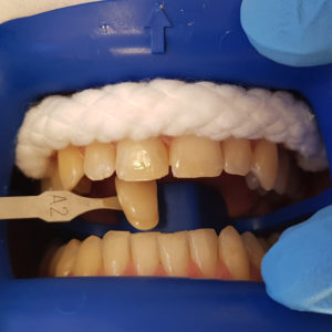 In Chair Teeth Whitening
