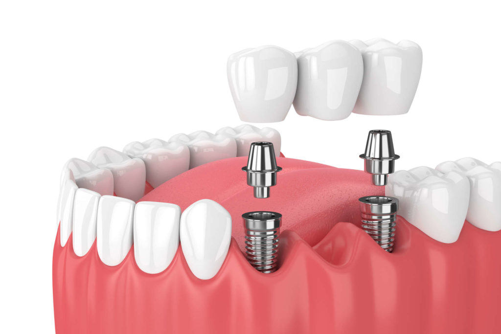 Dental Gigi Crown Bridge