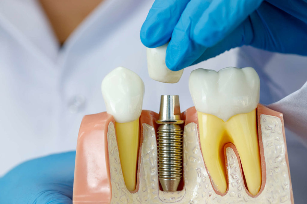Dental Gigi Implant