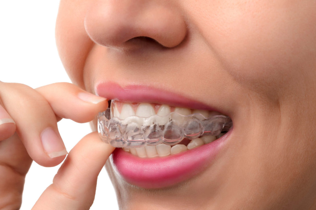 Dental Gigi Invisalign